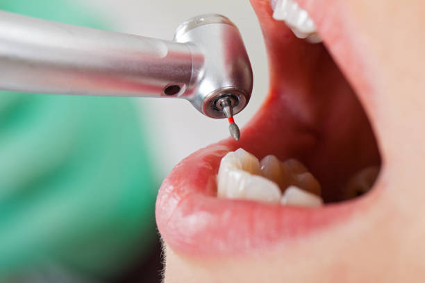 Best Emergency Treatment for Dental Infections or Abscesses in Eagle River, WI